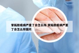 掌跖脓疱病严重了会怎么样 掌跖脓疱病严重了会怎么样图片