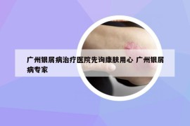 广州银屑病治疗医院先询康肤用心 广州银屑病专家