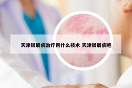 天津银屑病治疗用什么技术 天津银屑病吧