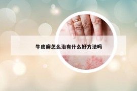 牛皮癣怎么治有什么好方法吗