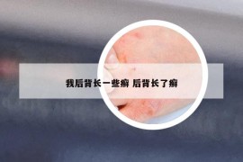 我后背长一些癣 后背长了癣