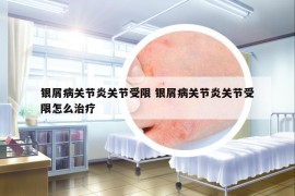 银屑病关节炎关节受限 银屑病关节炎关节受限怎么治疗