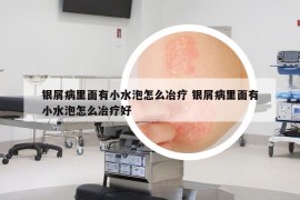 银屑病里面有小水泡怎么冶疗 银屑病里面有小水泡怎么冶疗好