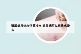 银屑病用热水还是冷水 银屑病可以用热水烫么