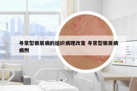 寻常型银屑病的组织病理改变 寻常型银屑病病例