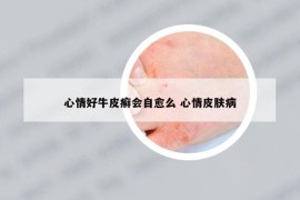 心情好牛皮癣会自愈么 心情皮肤病