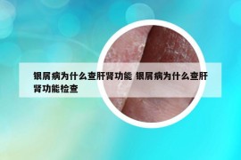 银屑病为什么查肝肾功能 银屑病为什么查肝肾功能检查