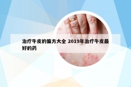 治疗牛皮的偏方大全 2019年治疗牛皮最好的药