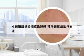 小孩银屑病能彻底治好吗 孩子银屑病治疗方法