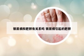 银屑病和肥胖有关系吗 银屑病引起的肥胖