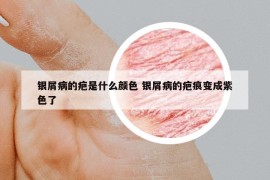 银屑病的疤是什么颜色 银屑病的疤痕变成紫色了