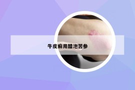 牛皮癣用醋泡苦参