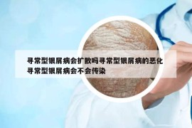 寻常型银屑病会扩散吗寻常型银屑病的恶化 寻常型银屑病会不会传染