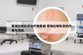 苯海拉明乳膏治疗银屑病 苯海拉明乳膏的作用与功效