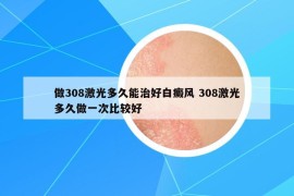 做308激光多久能治好白癜风 308激光多久做一次比较好