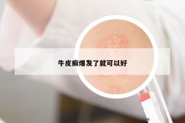 牛皮癣爆发了就可以好