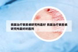 我国治疗银屑病研究所最好 我国治疗银屑病研究所最好的医院