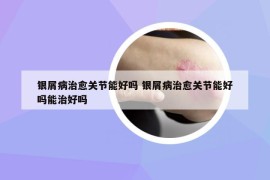 银屑病治愈关节能好吗 银屑病治愈关节能好吗能治好吗