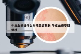 牛皮血癣症什么时候最容易长 牛皮血癣早期症状