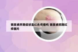 银屑病早期症状是红色疙瘩吗 银屑病初期红疹图片