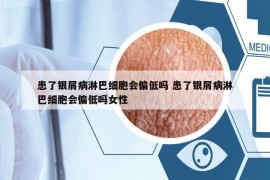 患了银屑病淋巴细胞会偏低吗 患了银屑病淋巴细胞会偏低吗女性