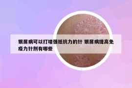 银屑病可以打增强抵抗力的针 银屑病提高免疫力针剂有哪些