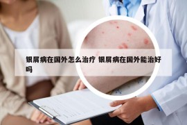 银屑病在国外怎么治疗 银屑病在国外能治好吗