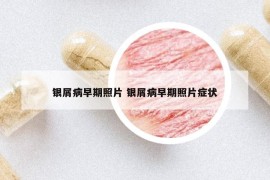 银屑病早期照片 银屑病早期照片症状