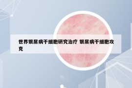 世界银屑病干细胞研究治疗 银屑病干细胞攻克