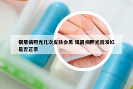 银屑病照光几次皮肤会黑 银屑病照光后发红是否正常