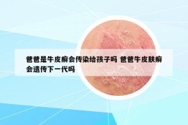 爸爸是牛皮癣会传染给孩子吗 爸爸牛皮肤癣会遗传下一代吗