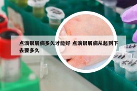 点滴银屑病多久才能好 点滴银屑病从起到下去要多久