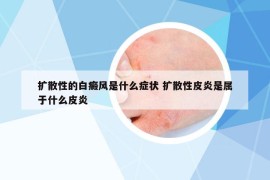 扩散性的白癜风是什么症状 扩散性皮炎是属于什么皮炎