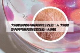 大腿根部内侧有癣类似的东西是什么 大腿根部内侧有癣类似的东西是什么原因