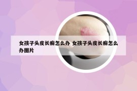 女孩子头皮长癣怎么办 女孩子头皮长癣怎么办图片