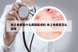 身上有癣是什么原因造成的 身上有癣是怎么回事