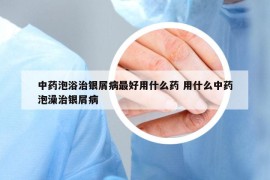 中药泡浴治银屑病最好用什么药 用什么中药泡澡治银屑病