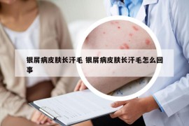 银屑病皮肤长汗毛 银屑病皮肤长汗毛怎么回事