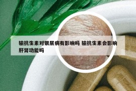 输抗生素对银屑病有影响吗 输抗生素会影响肝肾功能吗