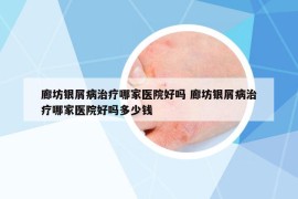 廊坊银屑病治疗哪家医院好吗 廊坊银屑病治疗哪家医院好吗多少钱