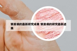 银屑病的最新研究成果 银屑病的研究最新进展