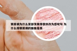 银屑病为什么背部发展得很快改为感叹句 为什么得银屑病的偏偏是我