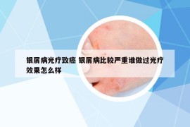 银屑病光疗致癌 银屑病比较严重谁做过光疗效果怎么样