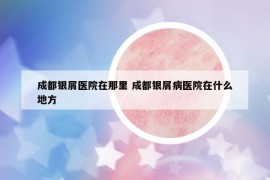 成都银屑医院在那里 成都银屑病医院在什么地方