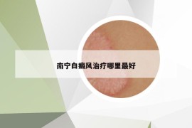 南宁白癜风治疗哪里最好