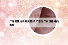 广东哪里治白癜风最好 广东治疗白斑最好的医院