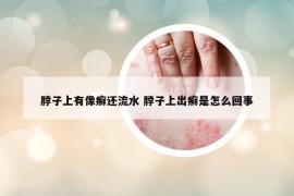 脖子上有像癣还流水 脖子上出癣是怎么回事