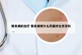 银肖病的治疗 银肖病用什么药最好北京京科 _