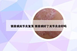 银屑病关节炎复发 银屑病好了关节炎会好吗