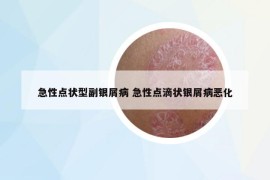 急性点状型副银屑病 急性点滴状银屑病恶化